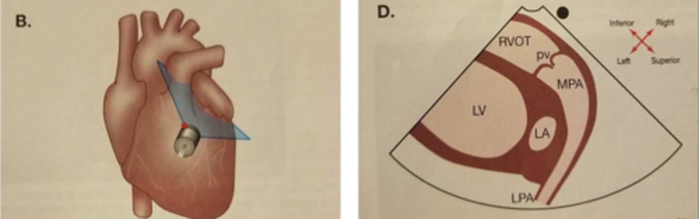 <p>PV-pulmonary valve (right and left leaflets)</p><p>PA-pulmonary artery.</p><p>*tilt face superior</p>