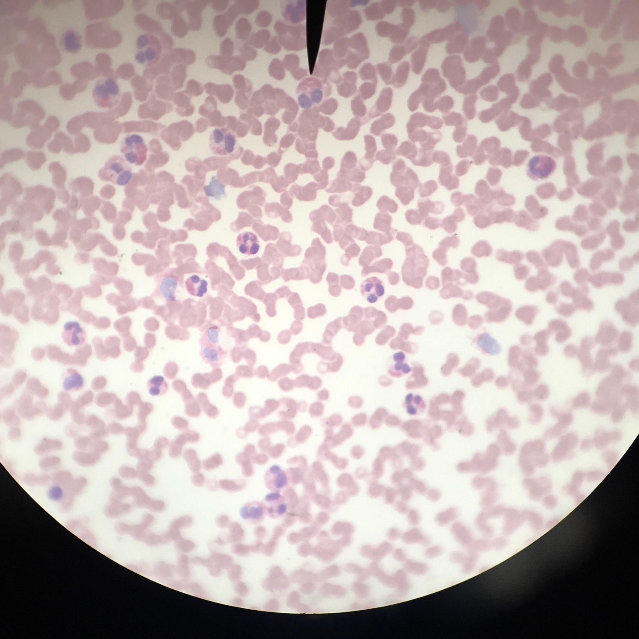 <ul><li><p>abundance of eosinophils&nbsp;</p></li><li><p>Occurs with caused by parasitic infections &amp; allergies&nbsp;</p></li></ul><p></p><p></p>