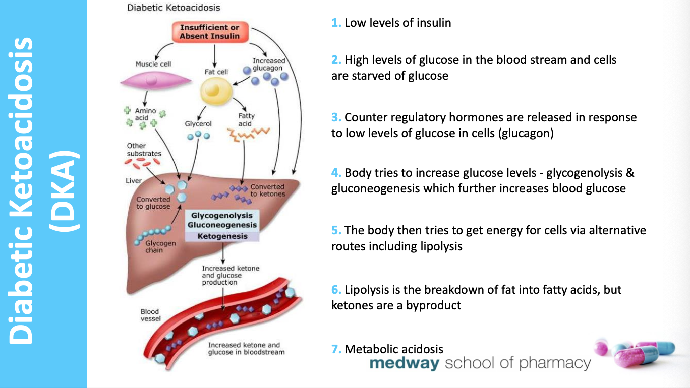 <p>Diagnosis:&nbsp;</p><ul><li><p>Blood sugar > 11mmol/l + clinical symptoms + ketones are high (2+ urine, 3mmol/l blood)</p></li><li><p>preventable but associated with mortality. most seen in T1DM as severe insulin deficiency.</p></li><li><p>can be first presentation of T1DM.</p></li></ul><p></p>