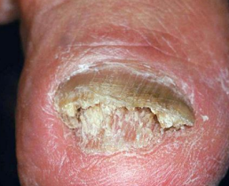 <p>fungal nail infection</p><p>-toenails are more commonly affected </p><p>-can also be due to yeasts and non-dermatophyte molds</p><p>-more common in elderly males </p>