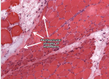 <p>BQ: Is this healthy and what tissue type is it?</p>