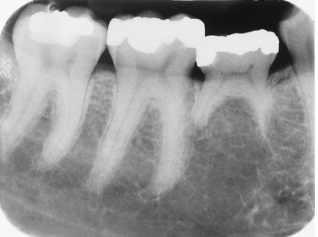 <p>What dental anomaly is seen in this image?</p><p> </p><p>dilaceration</p><p> </p><p>microdontia</p><p> </p><p>supernumerary tooth</p><p> </p><p>congenitally missing tooth</p>