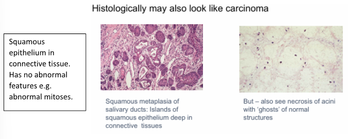 <p>Looks like carcinoma histologically</p><p>Islands of Squamous epithelium in connective tissue → no abnormal features e.g abnormal mitoses</p>