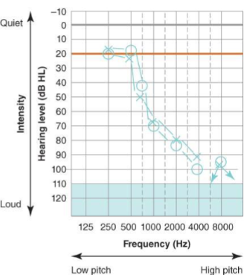 <p>What is a ski slope type of hearing loss?</p>