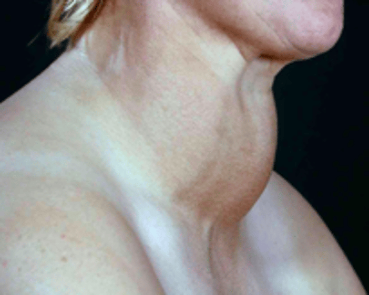 <p>patient presents with abnormal enlargement of the neck. Patient experiences swelling in the front of the neck (just below the Adam's apple) feeling of tightness in the throat area and hoarseness. Blood screening shows a normal calcium levels and low iodine levels. What is the diagnosis?</p>