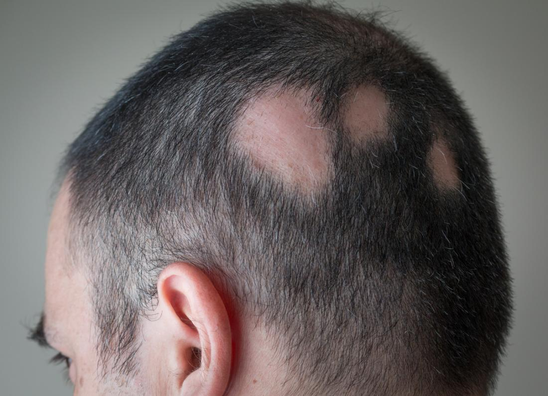 <p>Alopecia (hair loss)<br></p>