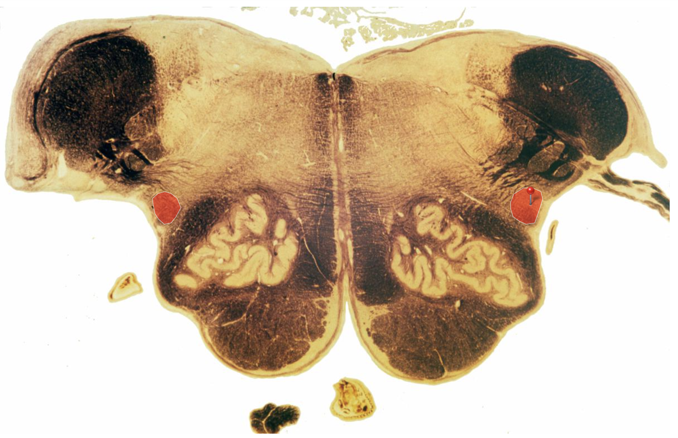 <p>Spinothalamic Tract —&gt; P&amp;T </p><p></p><p>Note how it has been pushed dorsally by the olives!</p>