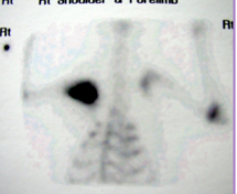 <p>Scintigraphy</p>