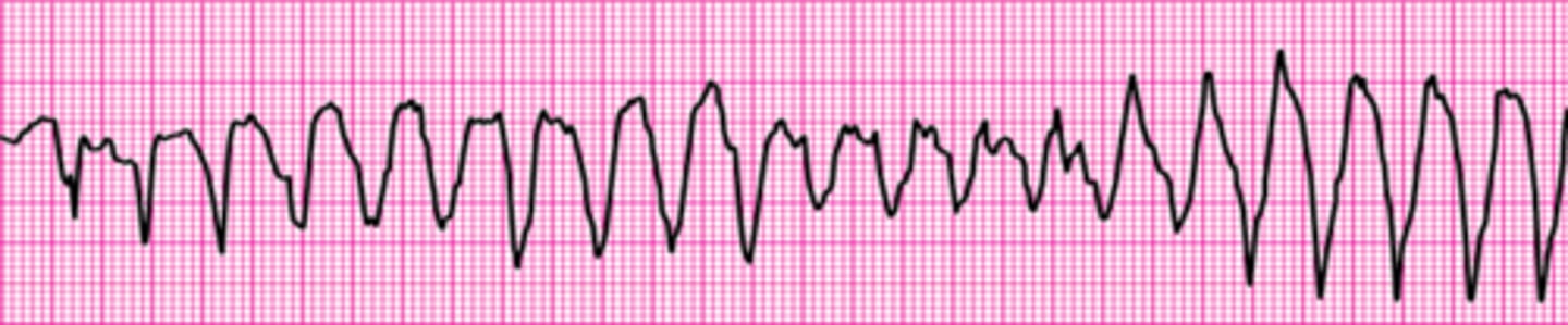 <p>Polymorphic Ventricular Tachycardia</p>