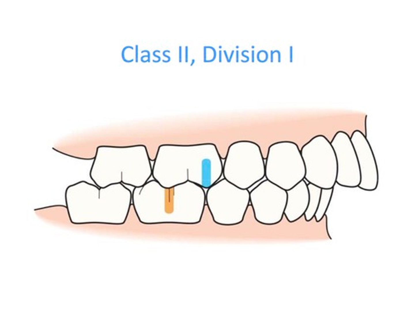 <p>overbite, front teeth tilted</p>