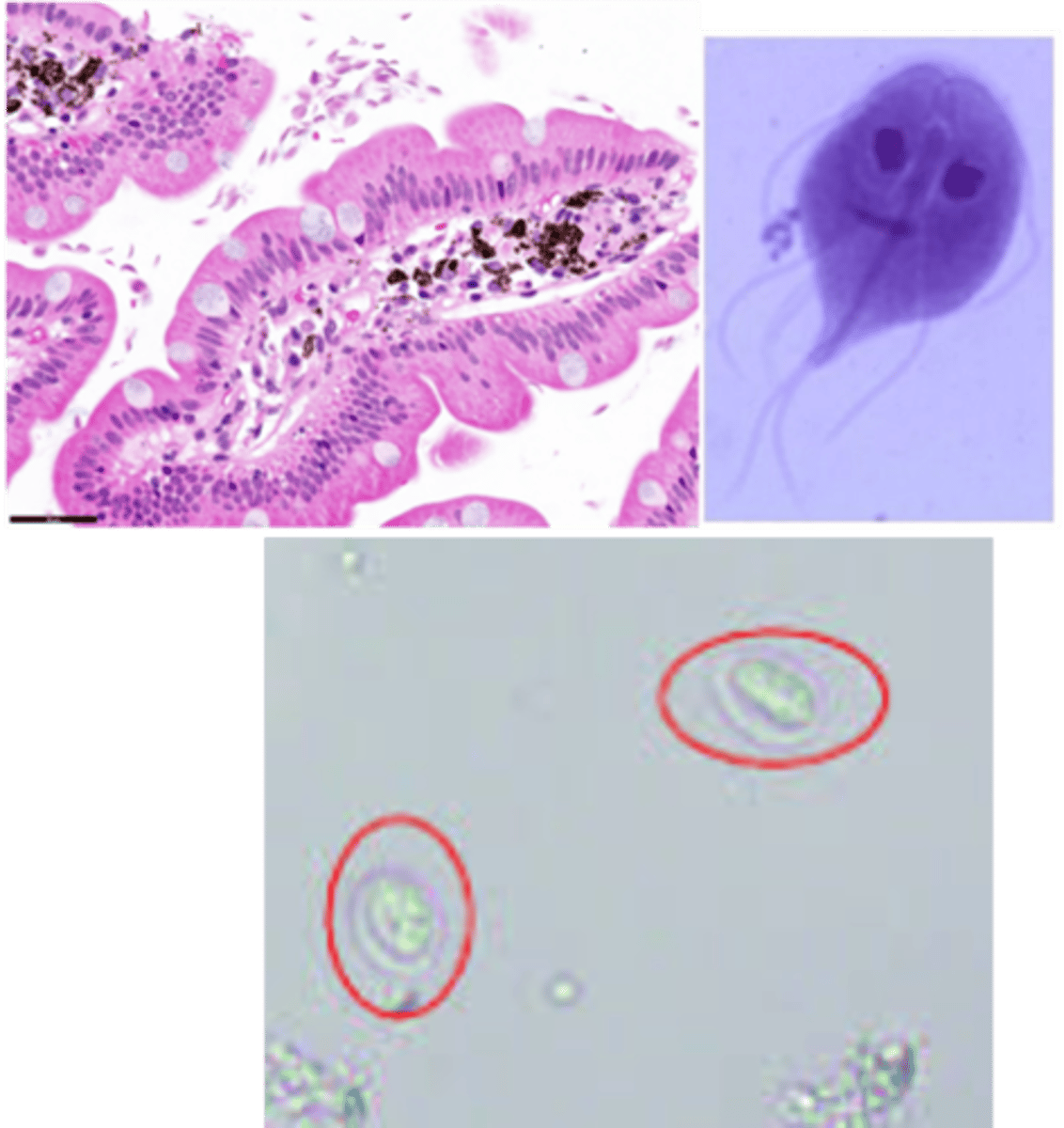 <p>Identify Pathogen causing Diarrhea:</p><p>Pear-shaped parasite, with hair-like flagella for motility</p><p>-Hx:</p><p>&gt; Fecal-Oral Transmission (cysts in stool --&gt; contaminate water)</p><p>&gt; Found in moist environments, esp in mountain streams</p><p>&gt; A/w campers/hikers</p><p>-Path: Ingested cysts from contaminated water -&gt; trophozoite in intestine ==&gt; ATTACHES (not invade) by sucking discs to microvilli in SI (Mainly Duodenum) ==&gt; Fat malabsorption</p><p>-Sx/PE:</p><p>&gt; Watery &amp; Fatty Diarrhea</p><p>&gt; Steatorrhea</p><p>-Dx:</p><p>&gt; Smear: Protozoan cysts &amp; Trophozoites in stool</p><p>&gt; ELISA: Antigens in Stool</p><p>&gt; Histology:</p><p>&gt;&gt; Pear to crescent-shaped trophozoites that usually float freely between the intestinal villi</p><p>&gt;&gt; Can sometimes cause blunting of villi, mimicking celiac disease</p>