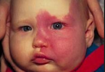 <p><strong>Port Wine Stain</strong></p><p>-____ flow vascular ____________ of dermal capillaries and postcapillary _______</p><p>-Unilateral, ___________, pink-red, sharply demarcated macule/patch</p><ul><li><p>May darken to _______ and develop a pebbly or thickened surface </p></li><li><p>Most common on ____</p></li></ul><p>-Typically isolated but can occur as part of complex malformation syndromes </p><p>-If eye is involved, refer to ophthalmology and maybe neurology </p><p>-Treatment </p><ul><li><p>Cosmetic improvement and prevention of ____________ (thickening, nodularity, bleeding) </p></li><li><p>Pulsed dye _______ therapy, which irreversibly damages _______ ______</p></li></ul><p></p>