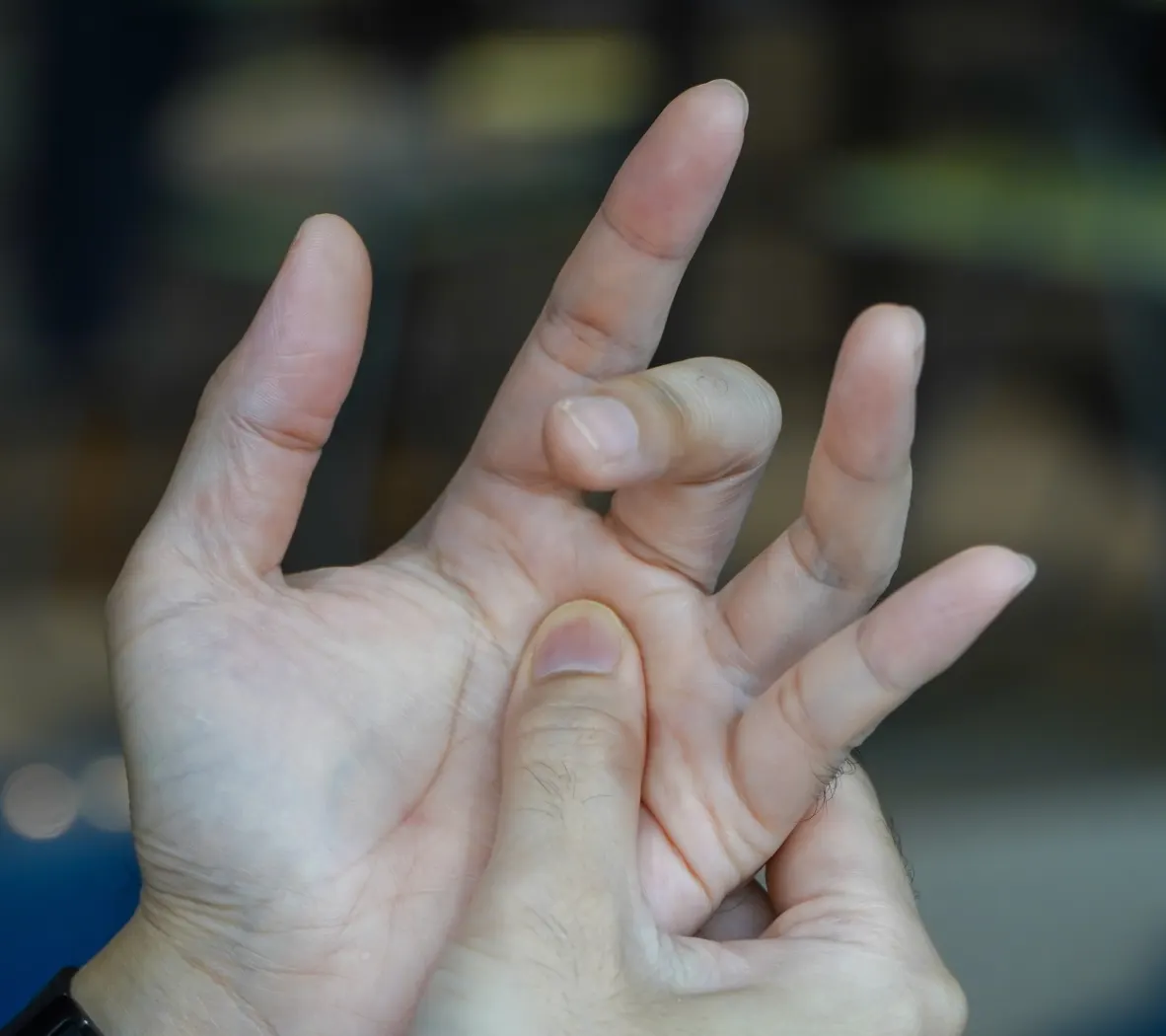 <p>A patient reports painful catching and locking when flexing the ring finger. Sometimes they need to use their other hand to “pop” the finger into extension. Palpation reveals tenderness over the flexor tendon sheath. What is the diagnosis?</p>