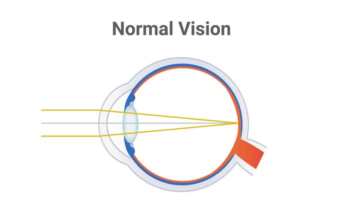 even normal eye focus

focal point is on retina 

20/20 vision
