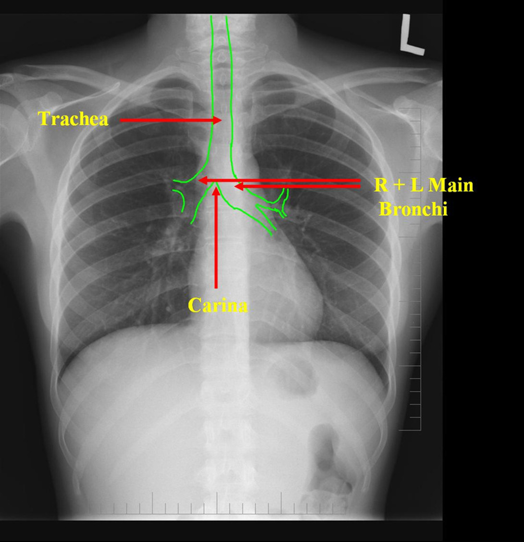 <p>Airway Structures on CXR</p>