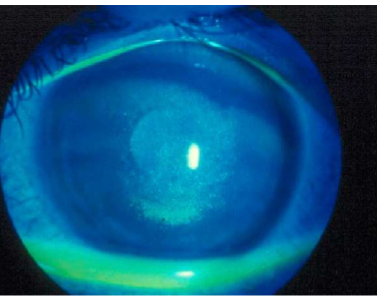 <ol><li><p>exposure keratopathy </p><ol><li><p>can lead to corneal ulceration, pannus, or perforation if not treaed </p></li></ol></li><li><p>due to the increased surface area of eye exposed to air —&gt; bc lids are retracted </p></li><li><p>also called SPK, PEE (loss of ep cells</p></li></ol><p></p>