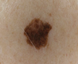 <p>An area that is usually distinguished by a color different from that of the surrounding tissue; it is flat and does not protrude above the surface of the normal tissue (freckle is an example of a macule)</p>
