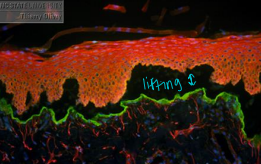 <p><span>Epidermolysis Bullosa Acquisita</span></p>