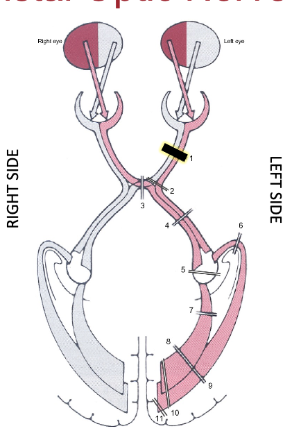 <p>distal optic nerve lesion; acute lesion or untreated progression typically causes</p>