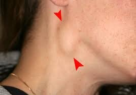 <p>Enlarged lymph nodes</p>