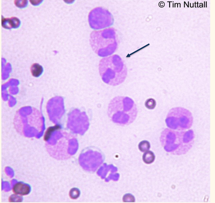<p>What are these cells and what do they indicate?</p>