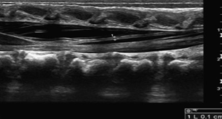 <p>Looking at this image of the filum terminale, would this be normal or abnormal?</p>