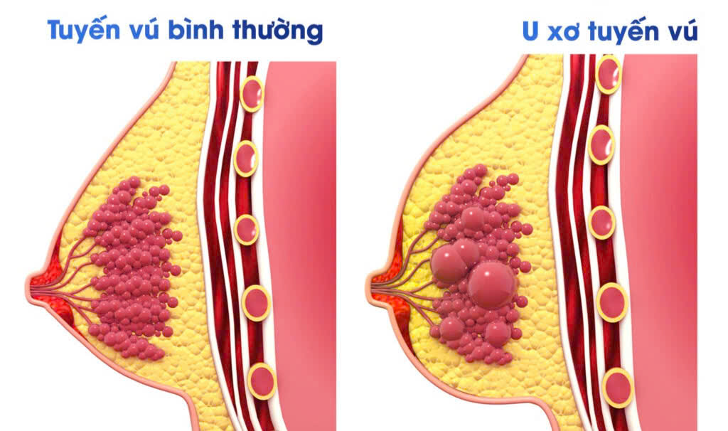 <p>u xơ tuyến vú</p>