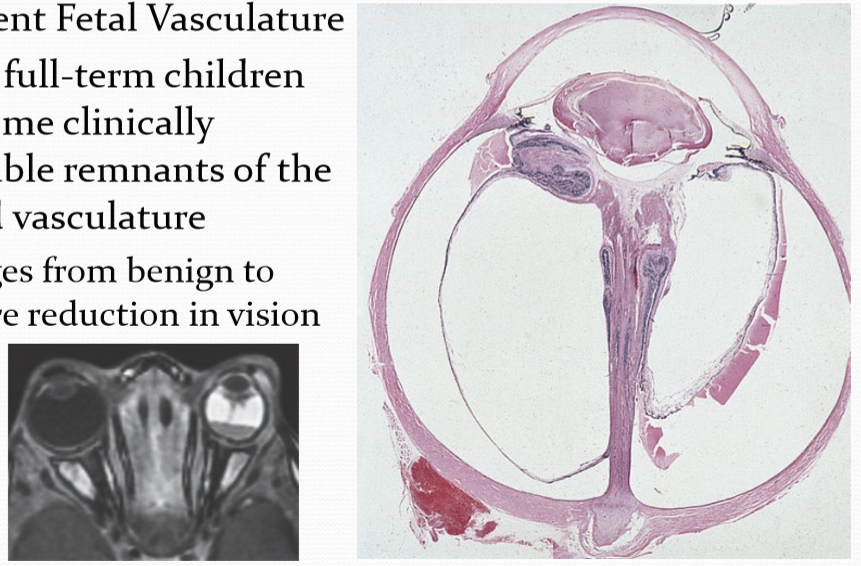 <p>When there are clinically detectable remnants of the hyaloid vasculature. Can rang from benign to severe reduction in vision. ~3% of fell-term children have some clinically detectable remnants of the hyaloid vasculature. </p>
