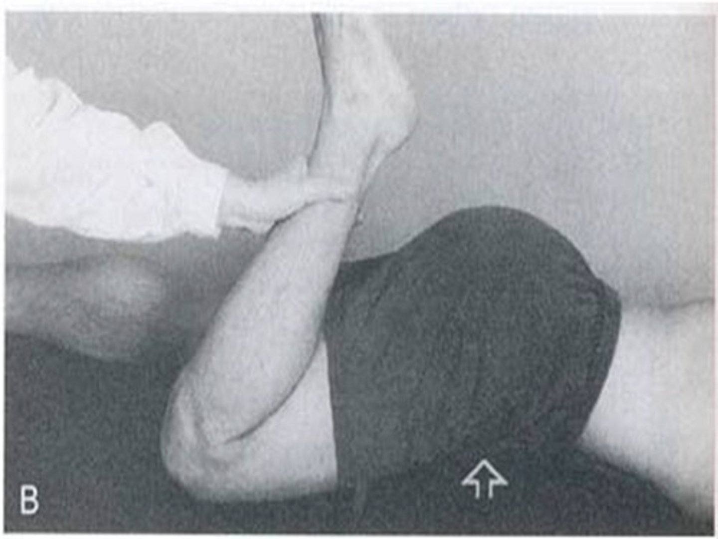 <p>Tightness of rectus femoris</p>