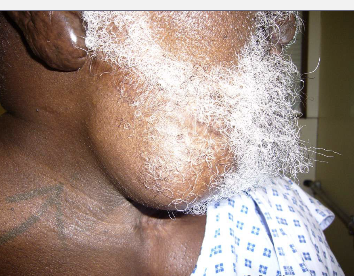 <p>mand, usually in molar region </p>