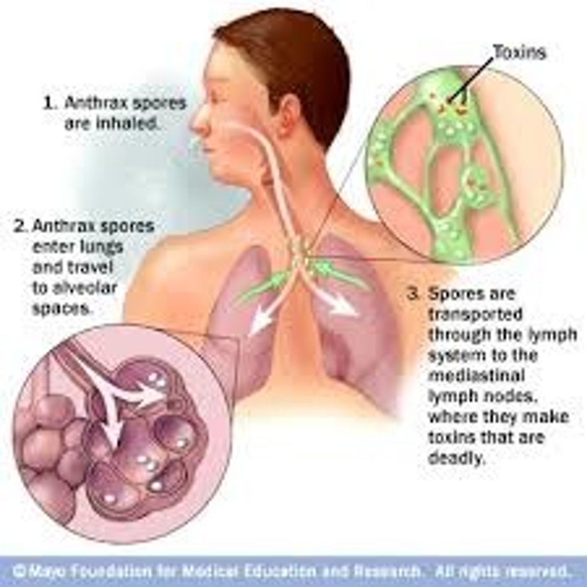 <p>breathing in spores.</p><p>fatal if not treated due to spores germinating in alveoli and producing cytoxins</p>