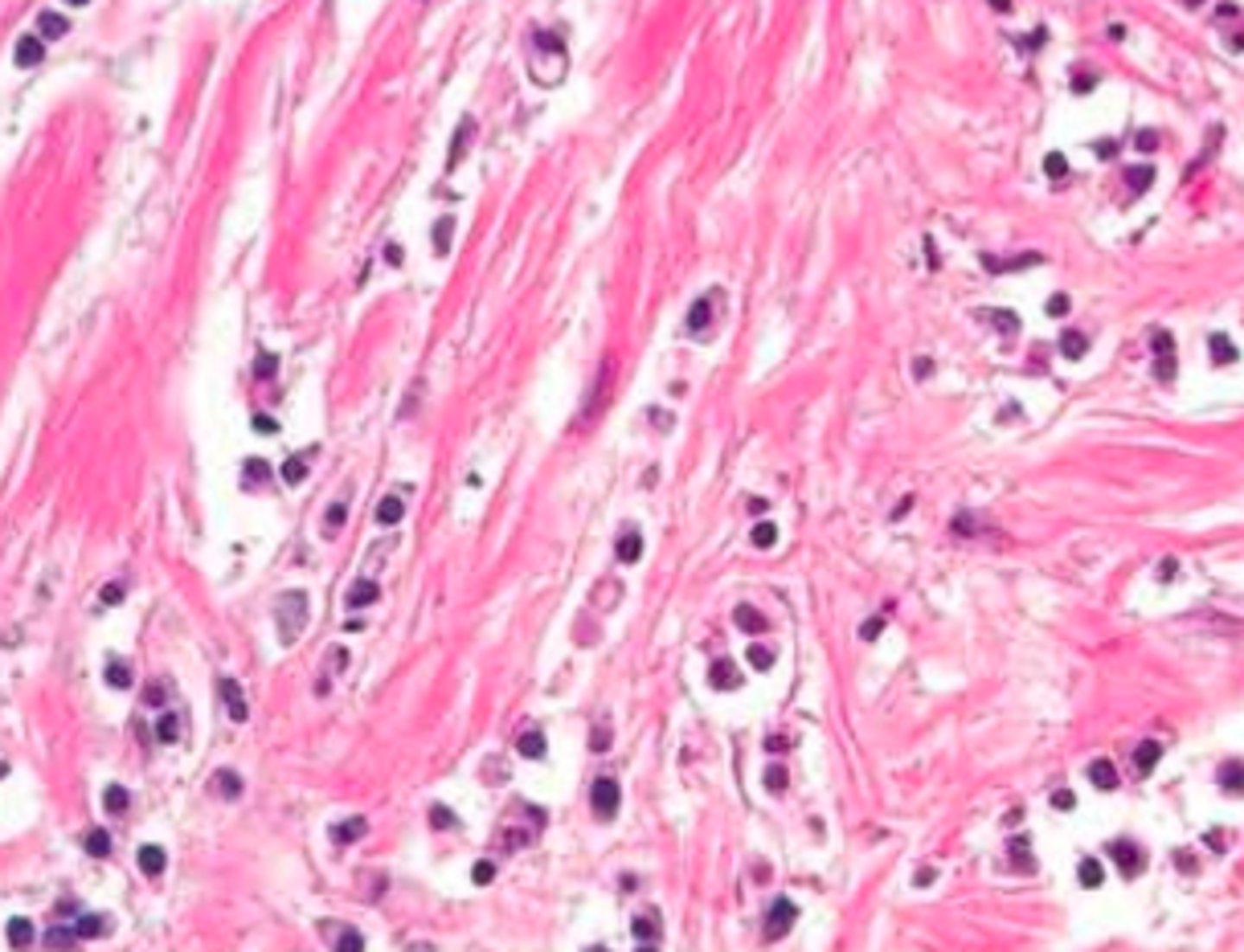 <p>Define Breast Cancer:</p><p>-Path: INVASIVE</p><p>&gt; Decrease E-cadherin</p><p>-Sx/PE: Bilateral w/ multiple lesions in same location</p><p>-Dx: Histo</p><p>&gt; Orderly row of cells ("single file") and NO duct formation</p><p>&gt; LACKS desmoplastic response (pervasive growth of dense fibrous tissue around the tumor)</p>