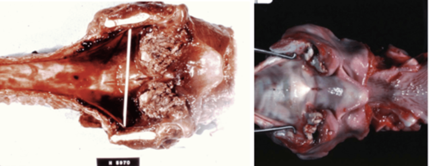 <p>- Bilateral necrotizing laryngitis</p>
