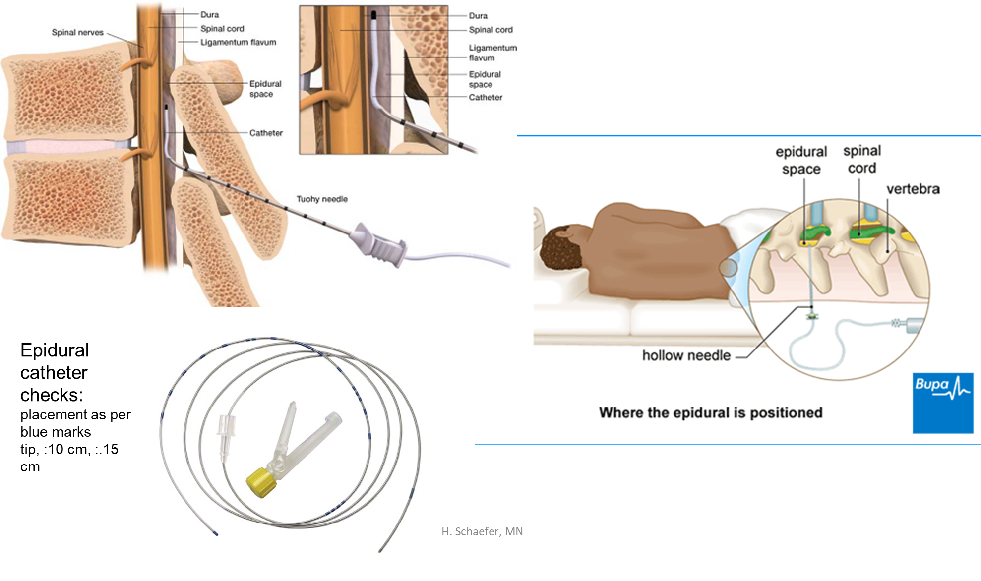 <p><span><span>Epidural catheter checks, where do we place it</span></span></p>