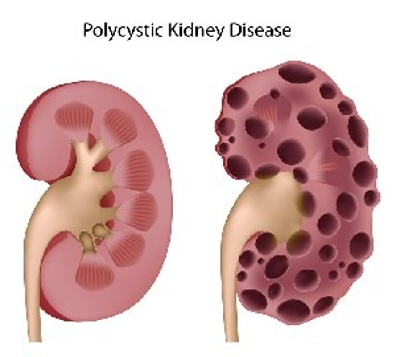 <p>... is een autosomaal dominante aandoening waarbij bilateraal multiple cysten aanwezig zijn. Deze geven finaal aanleiding tot nierinsufficiëntie en nood voor transplantatie.</p>
