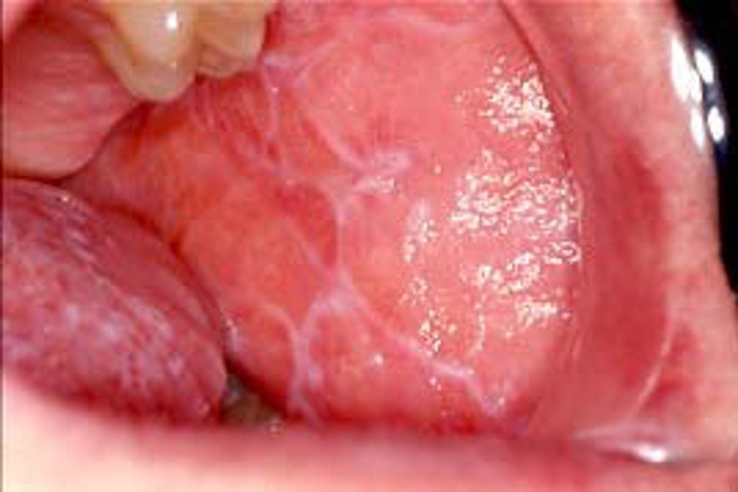 <p>A patient presents with bilateral white lacy striations on the buccal mucosa.</p><p>What ist he most likely diagnosis?</p>