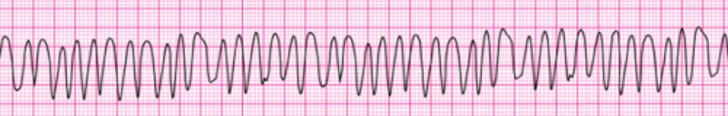 <p>This patient has been resuscitated from cardiac arrest. During the resuscitation, amiodarone 300 mg was administered. The patient developed severe chest discomfort with diaphoresis. He is now unresponsive. What is the next indicated action?</p><p>1. Perform immediate synchronized cardioversion.</p><p>2. Repeat amiodarone 150 mg IV.</p><p>3. Give an immediate unsynchronized high-energy shock (defibrillation dose).</p><p>4. Repeat amiodarone 300 mg IV.</p><p>5. Give lidocaine 1 to 1.5 mg/kg IV.</p>