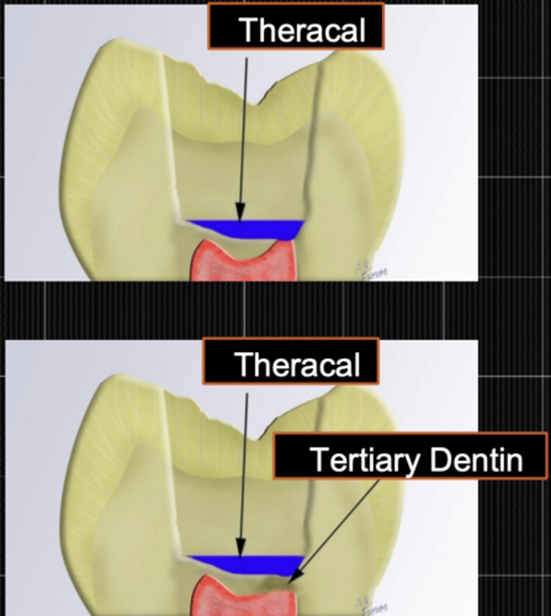 <p>- Direct pulp exposure</p><p>- Theracal onto pulp tissue</p><p>- vitrebond liner</p><p>- final restoration</p><p>Observe</p><p>- Extension of exposure</p><p>- Time until pulp capping done</p><p>- Bleeding control</p>