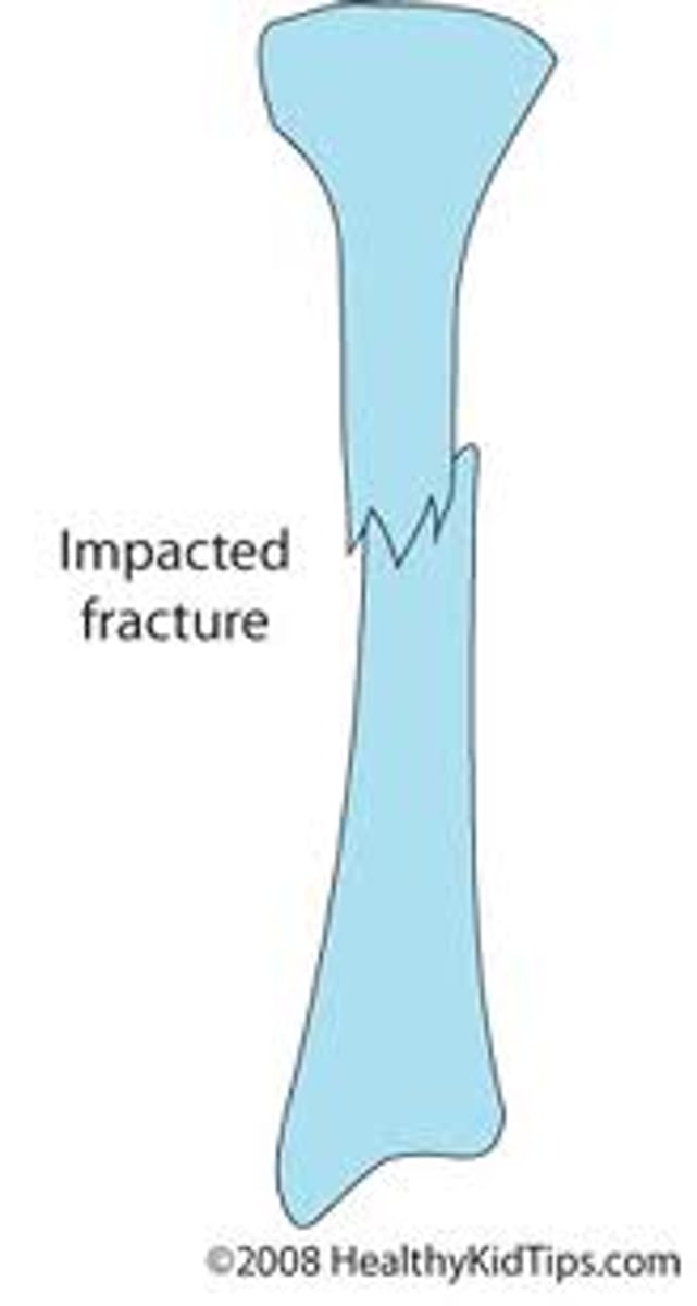 <p>instead of being pulled away, it is pushed down into rest of bone (ie land on something)</p>