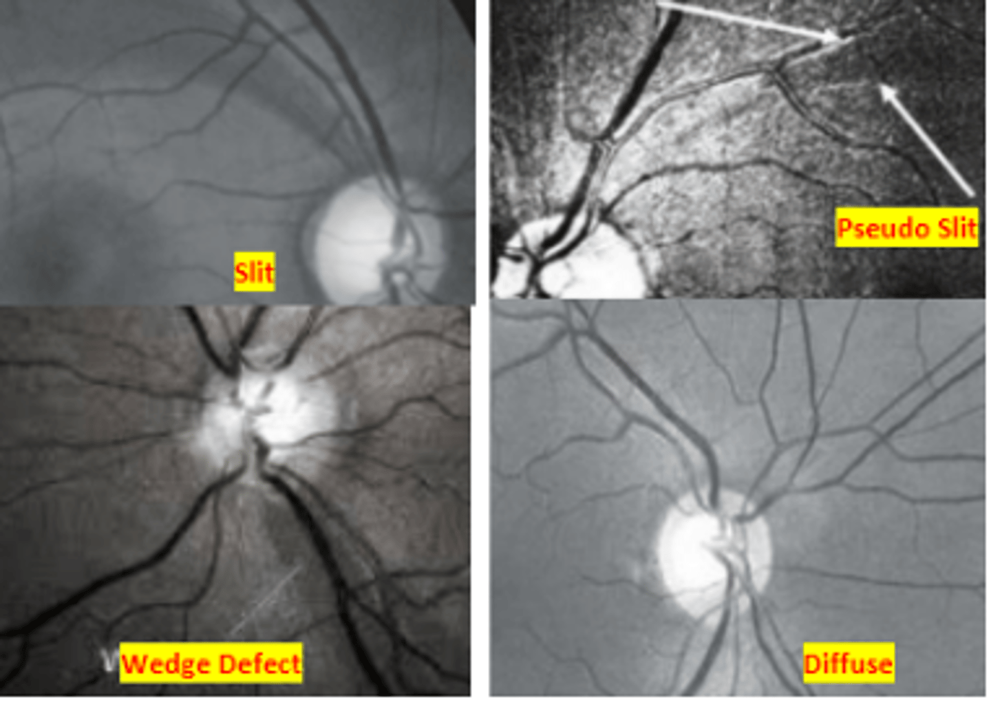 <p>Pseudo slit defects seen of the nerve fiber layer that do not extend all the way to the optic nerve head occur in ____% normal eyes</p>