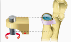 <ul><li><p>rounded end of one bone fits into ring of another</p></li><li><p>rotation</p></li><li><p>eg proximal radioulnar or antlantoaxial</p></li></ul><p></p>
