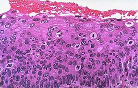 Squamous cell carcinoma of cervix. Sexually-active women are at risk of being infected. HPV serotypes 16, 18,31, 33 and 35 are associated w/ high-grade dysplasia and carcinoma
