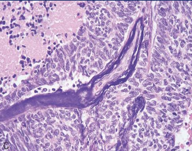<p>Carcinoma de células pequeñas, características celulares</p>