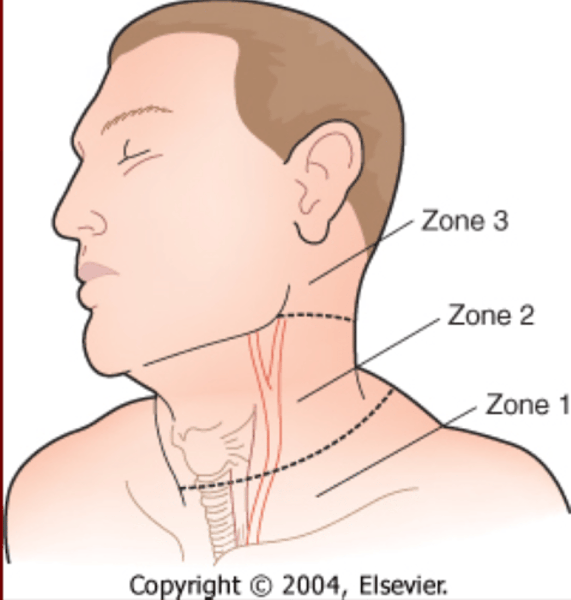 <p>Zone 1= Sternal Notch to Cricoid</p><p>Zone 2= Cricoid to Angle of Jaw </p><p>Zone 3= Angle of Jaw to Base Skull </p>