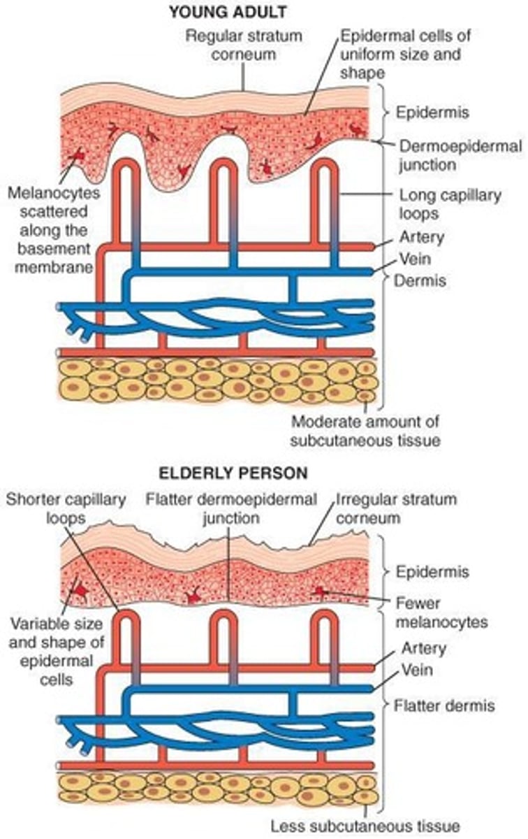 <p>Aging purple spots that occur due to less vascular dermis.</p>