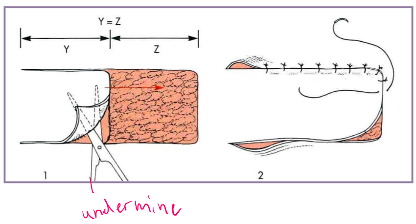 <ul><li><p>square or rectangle </p><ul><li><p>start at corners and work inward </p><ul><li><p>skin must be available on all four sides of defect </p></li></ul></li><li><p>advancement flaps </p></li></ul></li></ul><p></p>