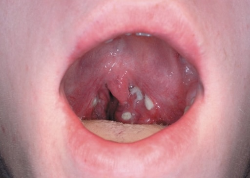 <p>Agent:<em> </em><span style="background-color: transparent;"><em><span>Streptococcal pharyngitis:</span></em></span></p><p><span style="background-color: transparent;"><u><span>Strep throat</span></u><span>: inflamed back of pharynx, with swollen lymph nodes and </span><strong><span>purulent abscesses covering the tonsils</span></strong><span>; pain during swallowing; </span><strong><span>bad breath</span></strong><span> </span></span></p><p><br><span style="background-color: transparent;"><span>•</span><u><span>Scarlet fever</span></u><span>- rash that begins on the chest and spreads through the body- tongue becomes strawberry read</span></span></p><p></p>