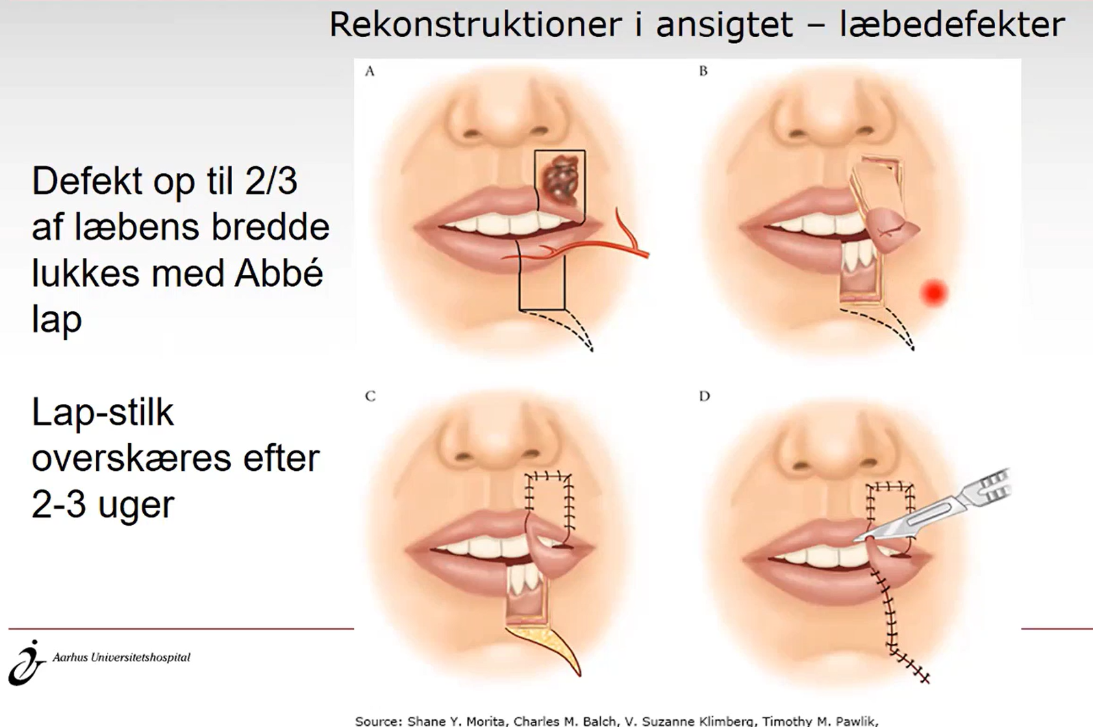 Lapp til å lukke defekt etter fjernelse av tumor i leppen

\-stilken overskæres efter 2-3 uger