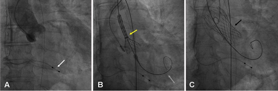 <p>what cath lab procedure is shown?</p>