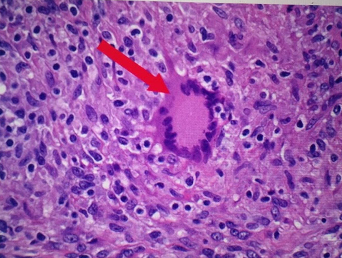 <p>multinucleate giant cell</p>
